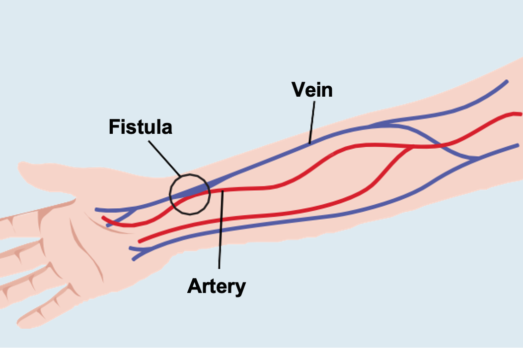 Diagram of vein and artery fistula connection in arm