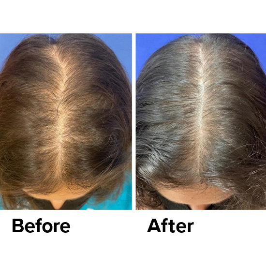 Platelet Rich Plasma (PRP) for hair loss and restoration.