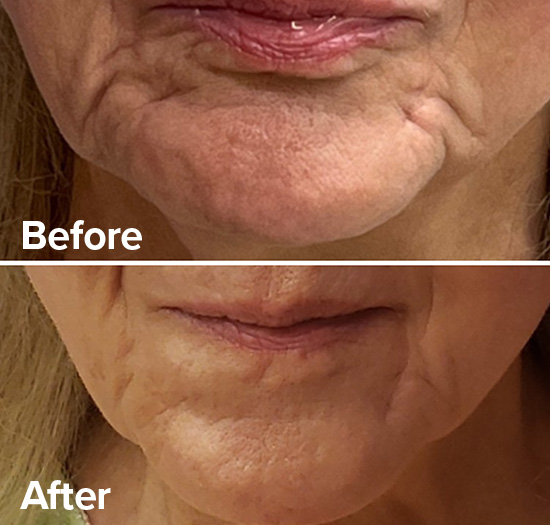 Radiesse® Filler to promote bio-stimulation, replace lost volume, and reduce wrinkles. 
