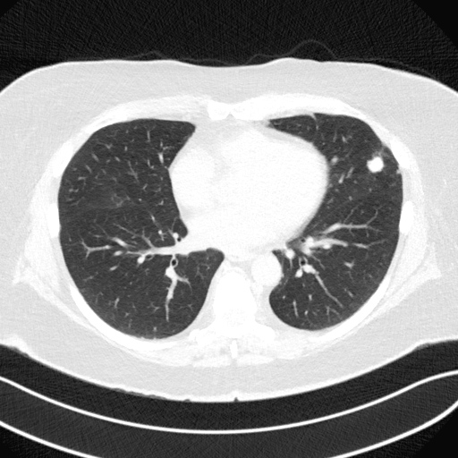 CT scan showing pulmonary nodules