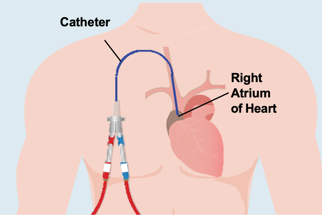 Image shows dialysis catheter inserted into chest wall near heart