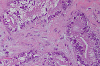 Why is Pancreatic Cancer So Difficult to Treat? New Clues Emerge