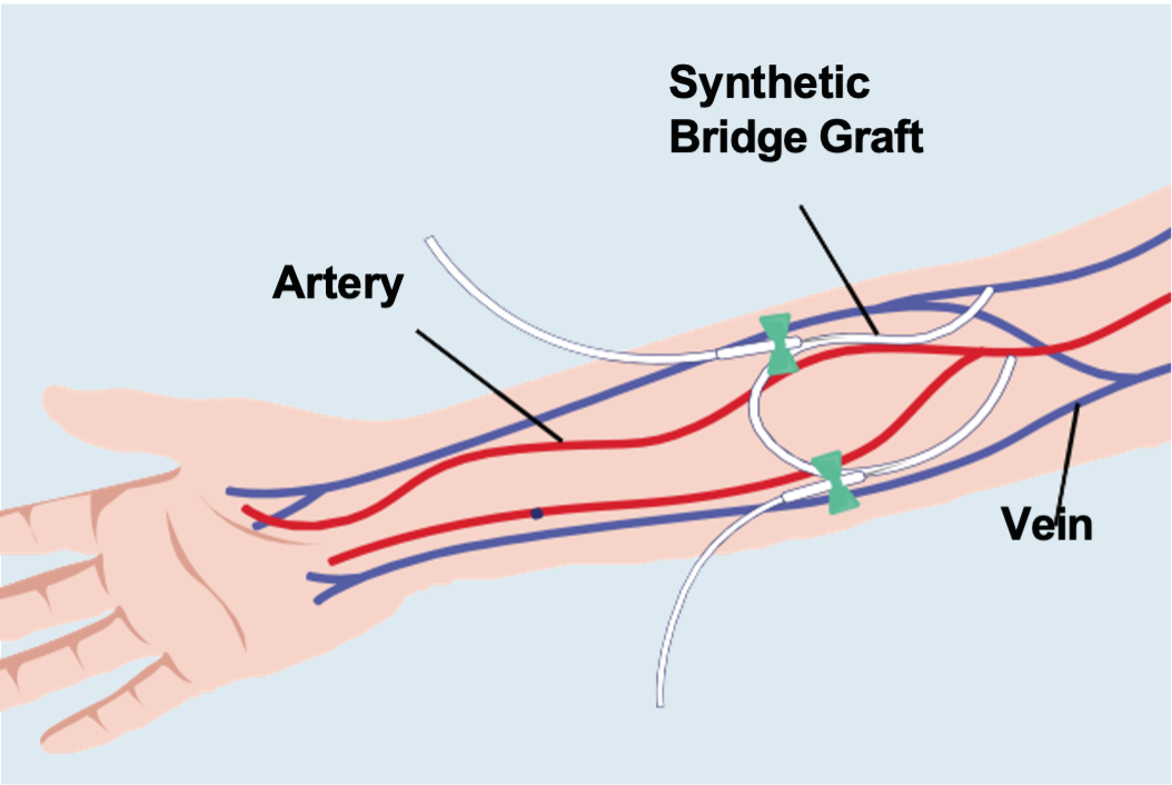 Diagram of Arteriovenous Graft in arm used for dialysis