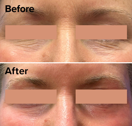 Contour TRL – ablative laser for crepey appearance and laxity around the eyes. 