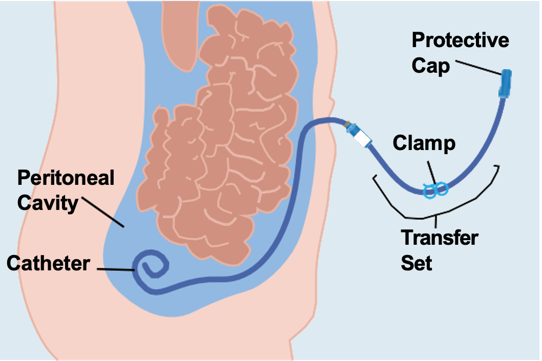 Diagram of catheter insterted into peritoneal cavity through abdomen
