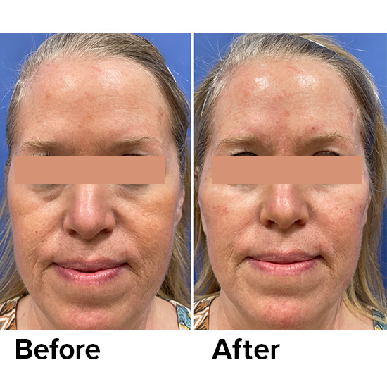 Radiesse®  Filler to promote bio-stimulation, replace lost volume, and reduce wrinkles.