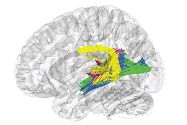 Black and white image of a brain mapping with colorful mapping areas