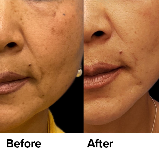 BBL™ (BroadBand Light) to minimize brown spots from sun damage.