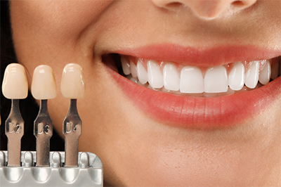 Should I Get Veneers? Consider These 5 Things First
