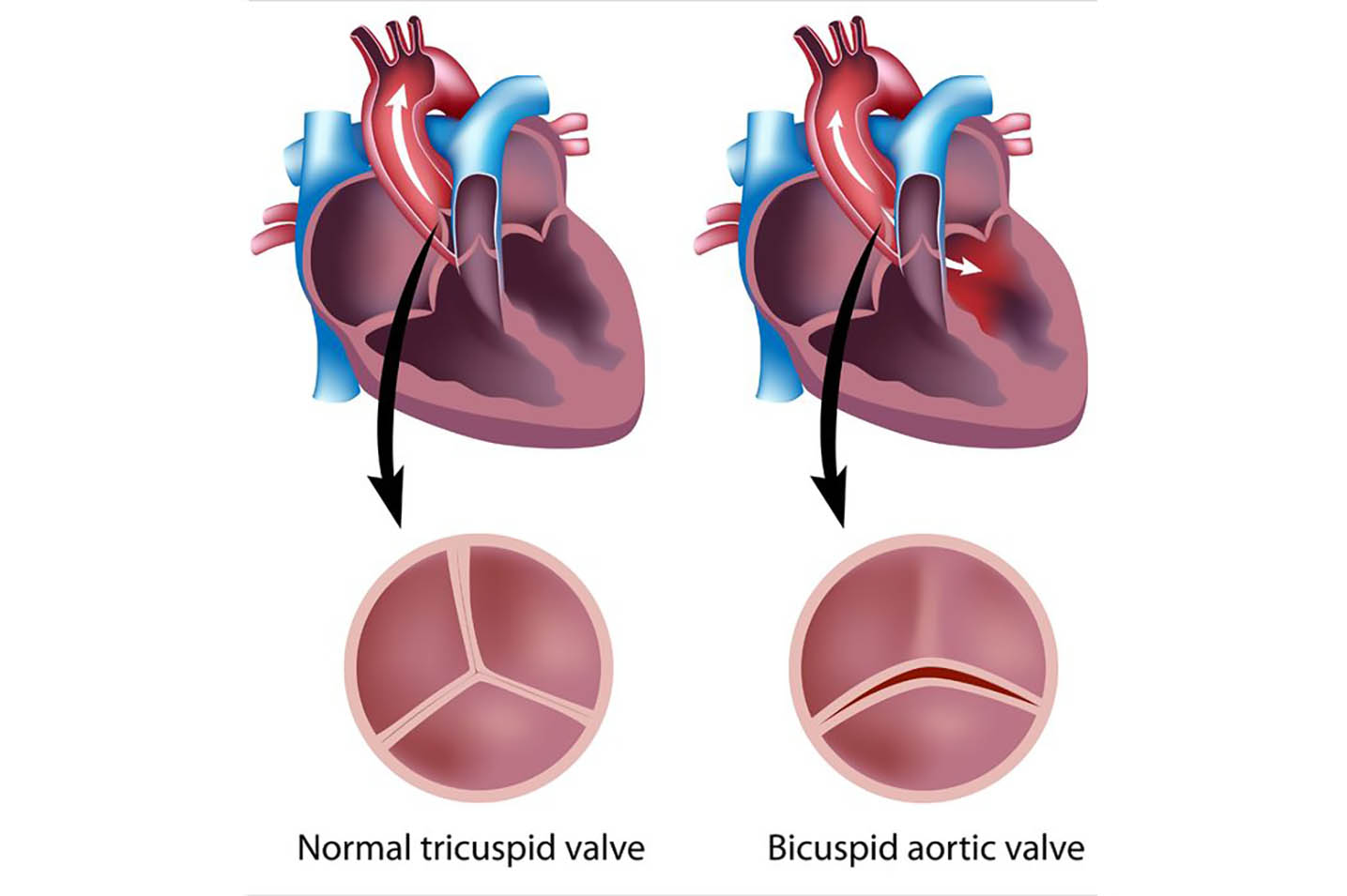 Diagram of normal tricuspid valve vs. bicuspid aortic valve