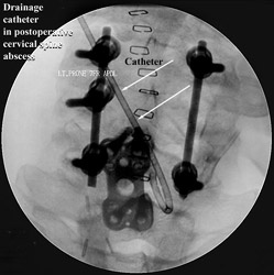 Disc ASpiration and Abscess Drainage