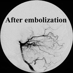 After embolization