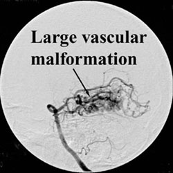 Large vascular malformation