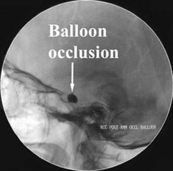 CC Fistula balloon occlusion