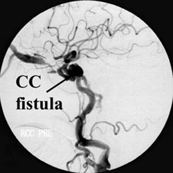 CC Fistula