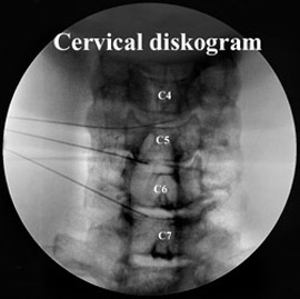 Cervical Discogram of C5, C6, and C7