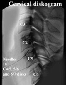 Cervical Discogram with needles in C4/5, 5/6 and 6/7