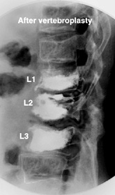 Compression Fractures treated with Vertebroplaty