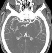 CT Angiogram of the Brain