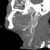 CT Angiogram of the Lower Mandible and Neck
