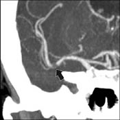 CT Angiogram of Artery with Contrast