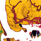 CT Angiogram of Artery with Contrast Material (Colored)