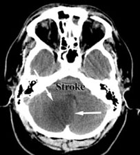 CT of Stroke
