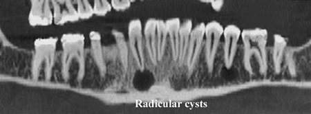 Radicular Cysts