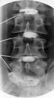 Lumbar discogram showcasing spinal spacing