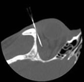 CT Guided Biopsy of a needle placed inferior to foramen ovale