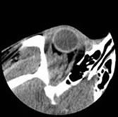 CT Guided Biopsy shows foramen ovale