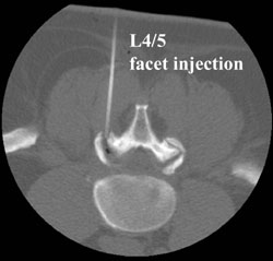 SI and Facet Joint Injection
