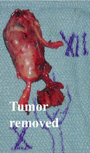 Tumor Removed