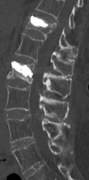 Placement of balloon to expand compressed vertebrae