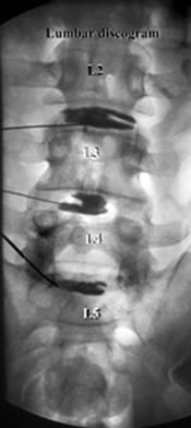 Lumbar discogram of 1.2, 1.3, 1.4, 1.5