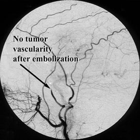 No tumor vascularity after embolization
