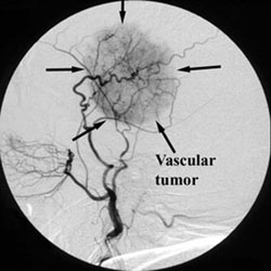 Vascular Tumor