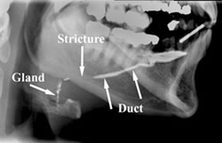 Sialogram 1