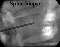 Spine Biopsy
