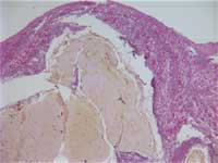 Figure 3: H & E stain of cecum shows marked thinning and necrosis