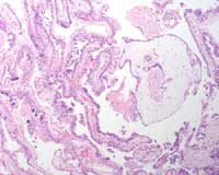 Figure 3: H & E stain of a partial hydatidiform mole (different case)