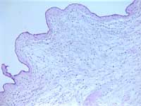 Figure 7: PMD edematous villus with simple trophoblast layer