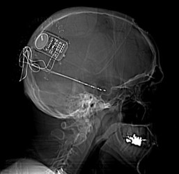 XRay Showing Responsive Neurostimulator System