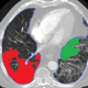 Interstitial Lung Disease Classification on High-resolution Chest CT
