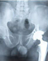 hipbone