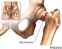 Hip Fracture
