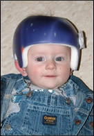 Child wearing helmet as treatment for plagiocephaly.
