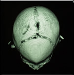 X-ray of craniosynostosis skull - top view