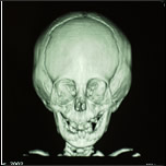 X-ray of craniosynostosis skull - front view