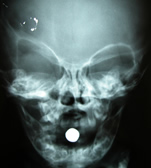 X-ray of craniostenosis skull - front view